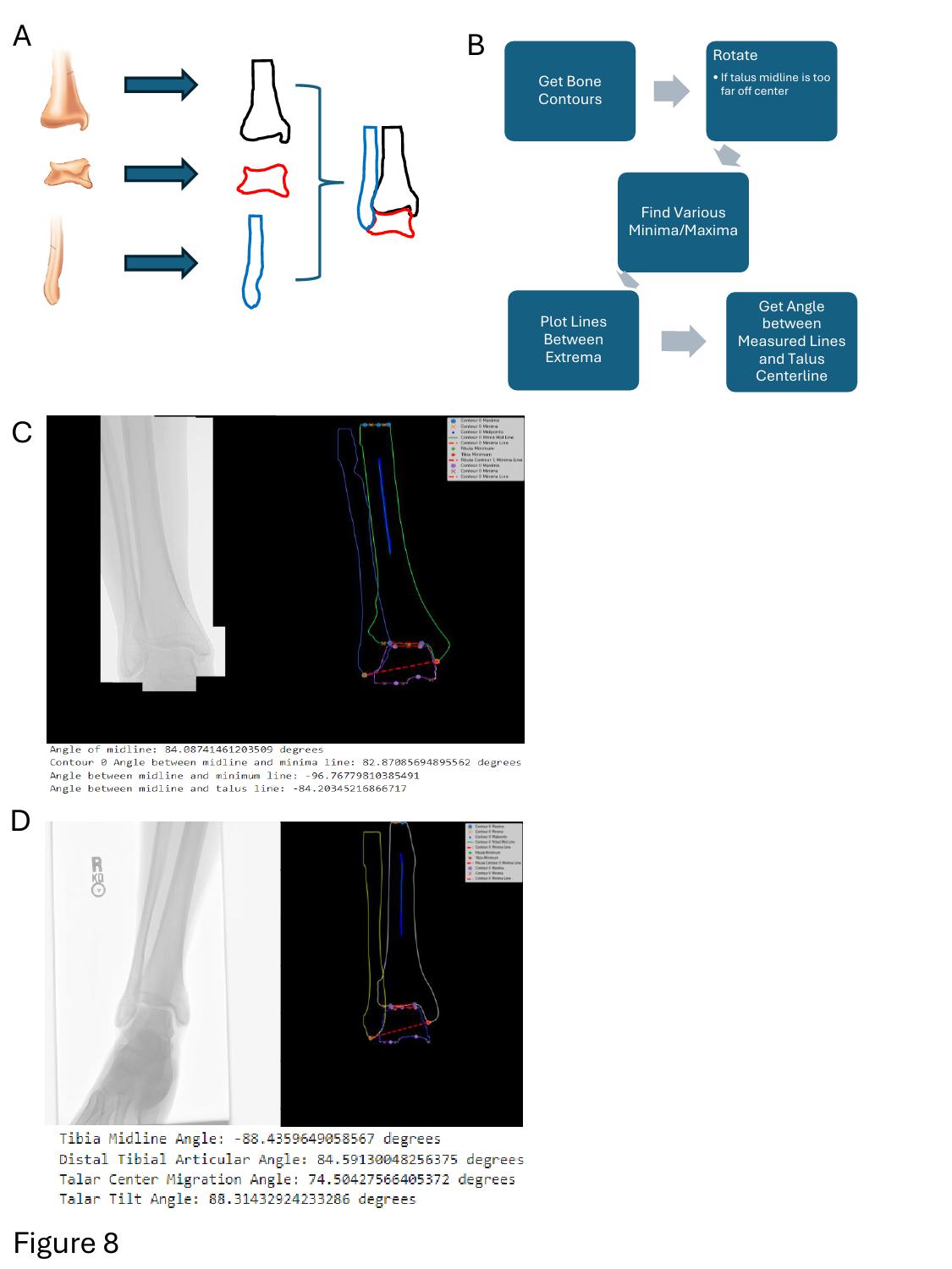 Ankle Replacement Figure 8